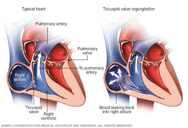 Tricuspid Valve Regurgitation | Heart Valve Disease